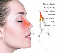 Deguna lāzerterapija